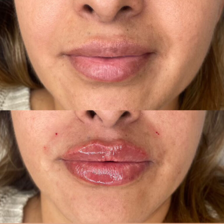 before and after lip augmentation closeup of lips female patient case 1542