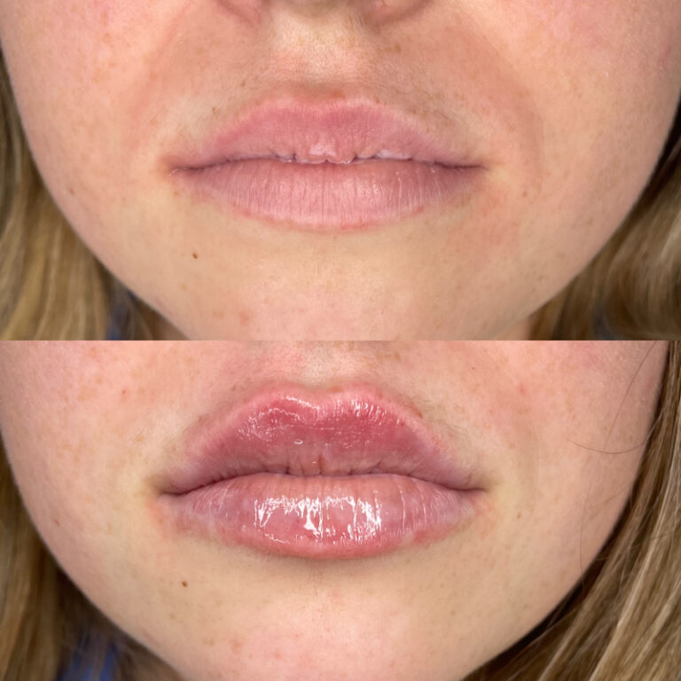 before and after lip augmentation closeup of lips female patient case 1544